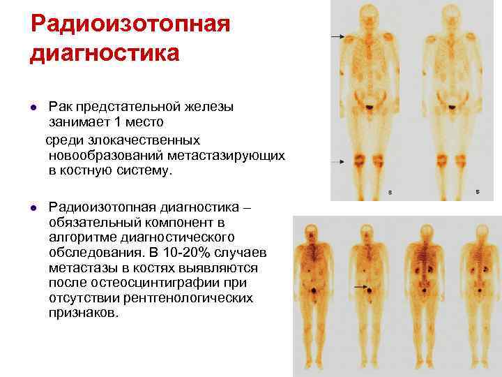 Радиоизотопная диагностика l l Рак предстательной железы занимает 1 место среди злокачественных новообразований метастазирующих