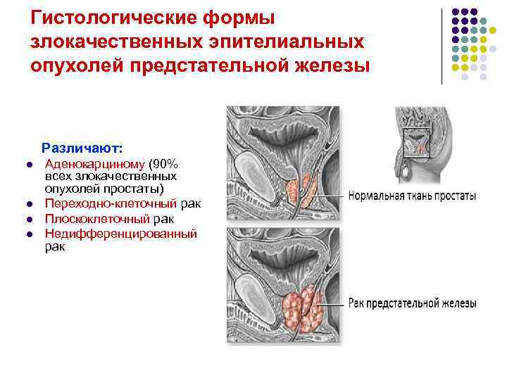 Гистологические формы злокачественных эпителиальных опухолей предстательной железы Различают: l l Аденокарциному (90% всех злокачественных