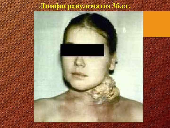 Лимфогранулематоз 3 б. ст. 