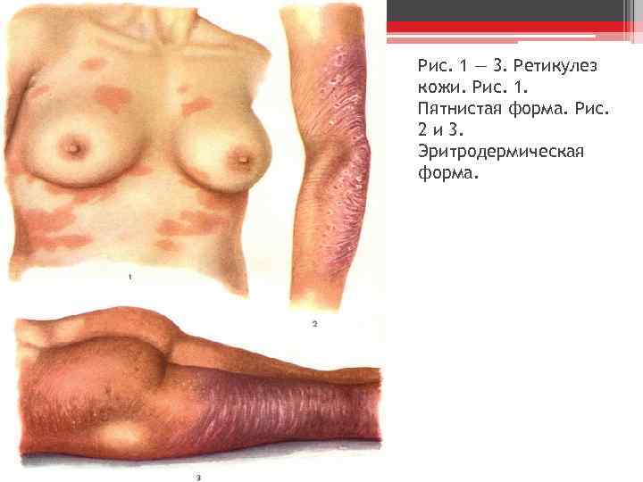 Рис. 1 — 3. Ретикулез кожи. Рис. 1. Пятнистая форма. Рис. 2 и 3.