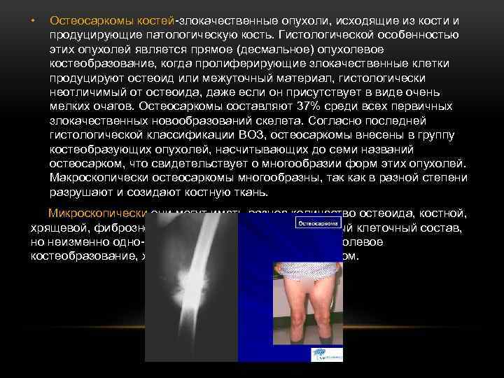  • Остеосаркомы костей-злокачественные опухоли, исходящие из кости и продуцирующие патологическую кость. Гистологической особенностью
