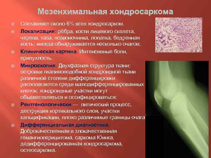 Диагноз кости. Остеосаркома и хондросаркома. Мезенхимальная хондросаркома гистология. Хондросаркома осложнения. Хондросаркома этиология.