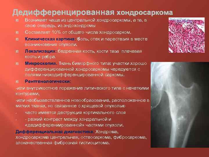 Опухоль из хрящевой ткани. Хондросаркома бедренной кости. Хондросаркома патанатомия. Вторичная хондросаркома g2. Периферическая хондросаркома рентген.