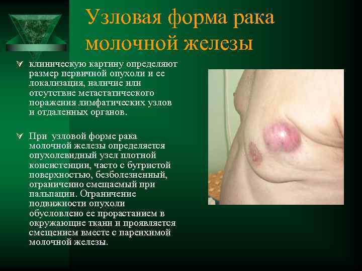 Узловая форма рака молочной железы Ú клиническую картину определяют размер первичной опухоли и ее