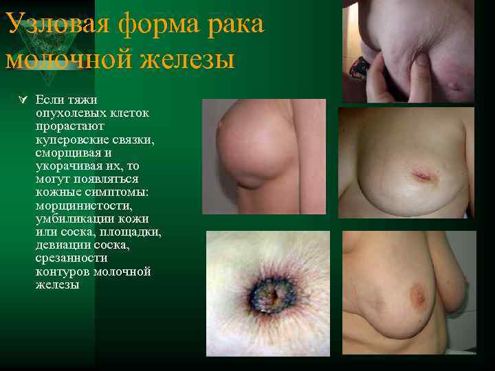 Узловая форма рака молочной железы Ú Если тяжи опухолевых клеток прорастают куперовские связки, сморщивая