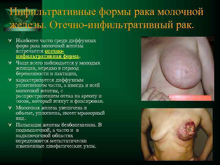 Инфильтративные формы рака молочной железы. Отечно инфильтративный рак. Ú Наиболее часто среди диффузных Ú