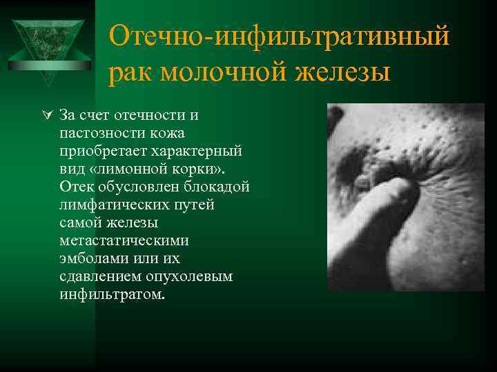 Отечно инфильтративный рак молочной железы Ú За счет отечности и пастозности кожа приобретает характерный