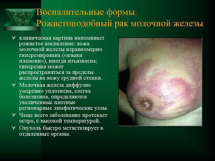 Воспалительные формы. Рожистоподобный рак молочной железы Ú клиническая картина напоминает рожистое воспаление: кожа молочной