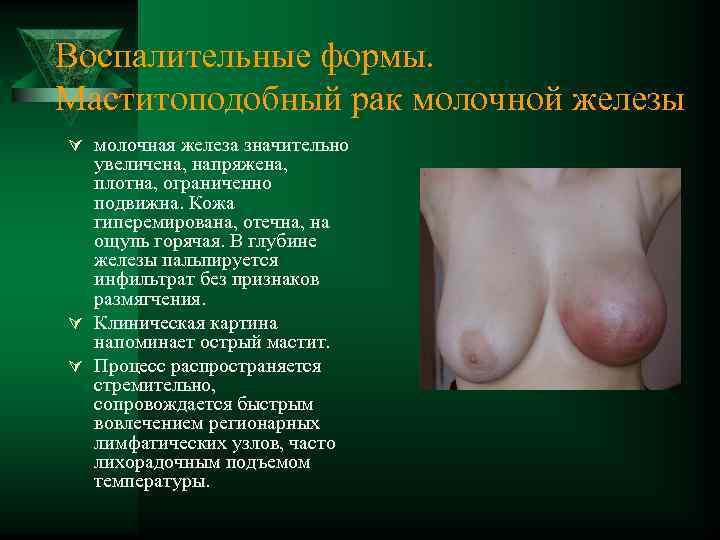 Воспалительные формы. Маститоподобный рак молочной железы Ú молочная железа значительно увеличена, напряжена, плотна, ограниченно
