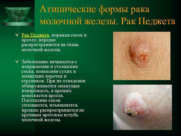 Атипические формы рака молочной железы. Рак Педжета Ú Рак Педжета, поражая сосок и ареолу,