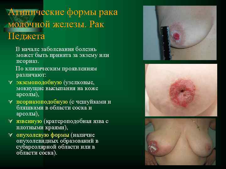 Атипические формы рака молочной железы. Рак Педжета В начале заболевания болезнь может быть принята