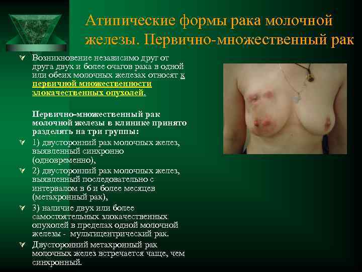 Атипические формы рака молочной железы. Первично множественный рак Ú Возникновение независимо друг от друга
