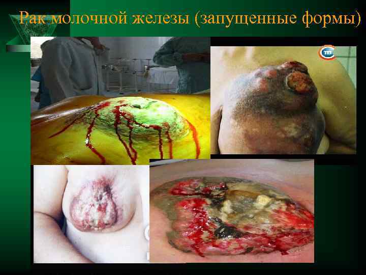 Рак молочной железы (запущенные формы) 