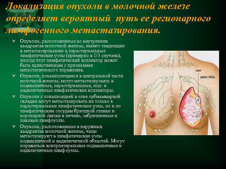 Локализация опухоли в молочной железе определяет вероятный путь ее регионарного лимфогенного метастазирования. Ú Опухоли,