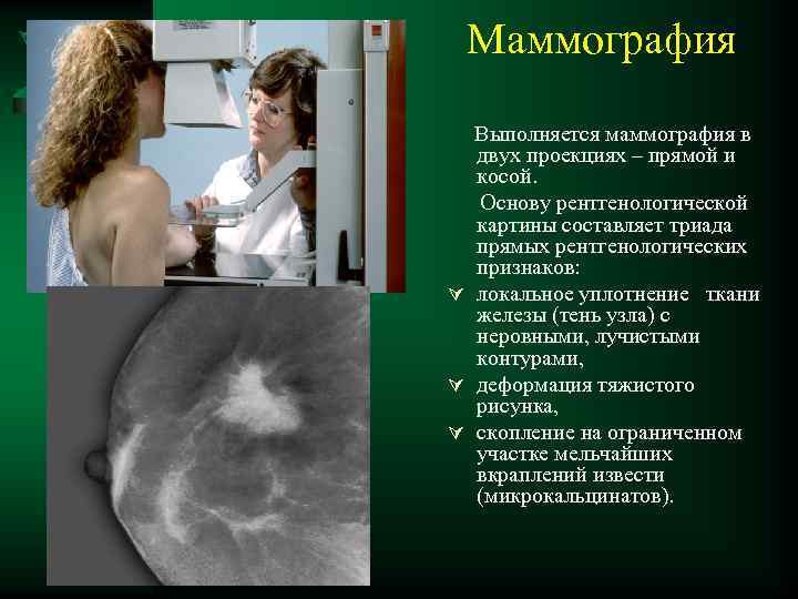 Маммография Выполняется маммография в двух проекциях – прямой и косой. Основу рентгенологической картины составляет