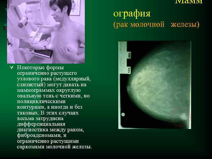 Мамм ография (рак молочной железы) Ú Некоторые формы ограниченно растущего узлового рака (медуллярный,