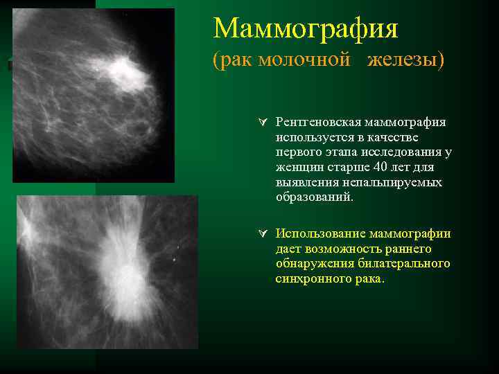 Маммография (рак молочной железы) Ú Рентгеновская маммография используется в качестве первого этапа исследования у