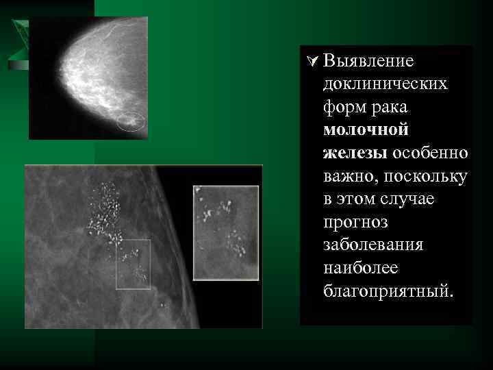 Ú Выявление доклинических форм рака молочной железы особенно важно, поскольку в этом случае прогноз