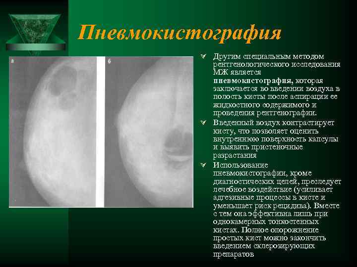 Пневмокистография Ú Другим специальным методом рентгенологического исследования МЖ является пневмокистография, которая заключается во введении