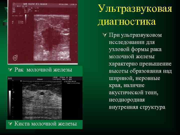 Ультразвуковая диагностика Ú При ультразвуковом Ú Рак молочной железы Ú Киста молочной железы исследовании