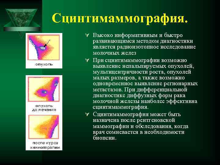 Сцинтимаммография. Ú Высоко информативным и быстро развивающимся методом диагностики является радиоизотопное исследование молочных желез