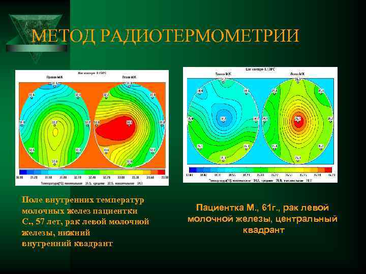 МЕТОД РАДИОТЕРМОМЕТРИИ Поле внутренних температур молочных желез пациентки С. , 57 лет, рак левой