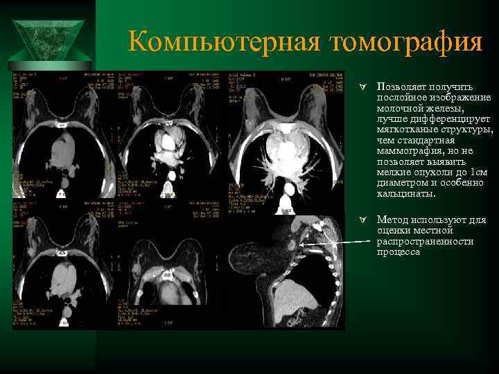 Компьютерная томография Ú Позволяет получить послойное изображение молочной железы, лучше дифференцирует мягкотканые структуры, чем