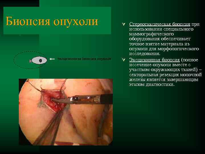 Биопсия опухоли эксцизионная биопсия опухоли Ú Стереотаксическая биопсия при использовании специального маммографического оборудования обеспечивает