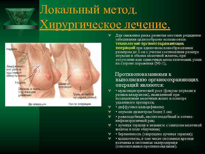 Локальный метод. Хирургическое лечение. Ú Для снижения риска развития местных рецидивов заболевания целесообразно использовать