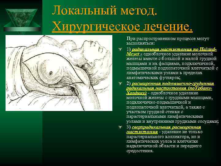 Локальный метод. Хирургическое лечение. При распространенном процессе могут выполняться: Ú 1) радикальная мастэктомия по
