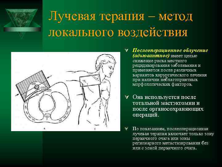 Лучевая терапия – метод локального воздействия Ú Послеоперационное облучение (адьювантное) имеет целью снижение риска