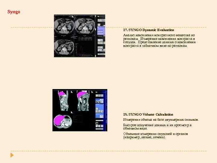 Syngo 27. SYNGO Dynamic Evaluation Анализ накопления контрастного вещества по регионам. Измерение накопления контраста