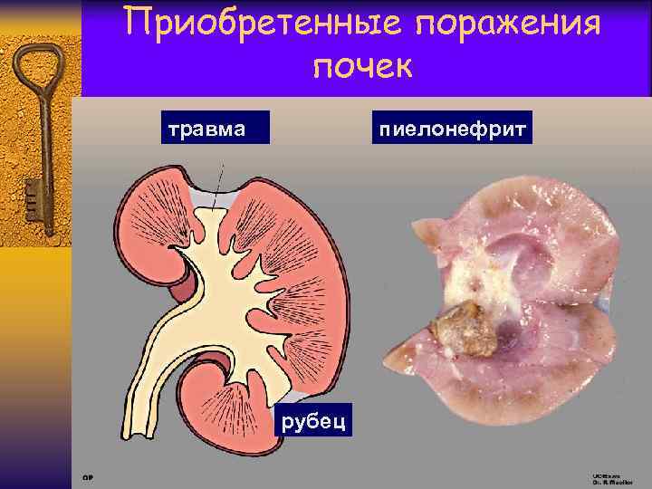 Приобретенные поражения почек травма пиелонефрит рубец 