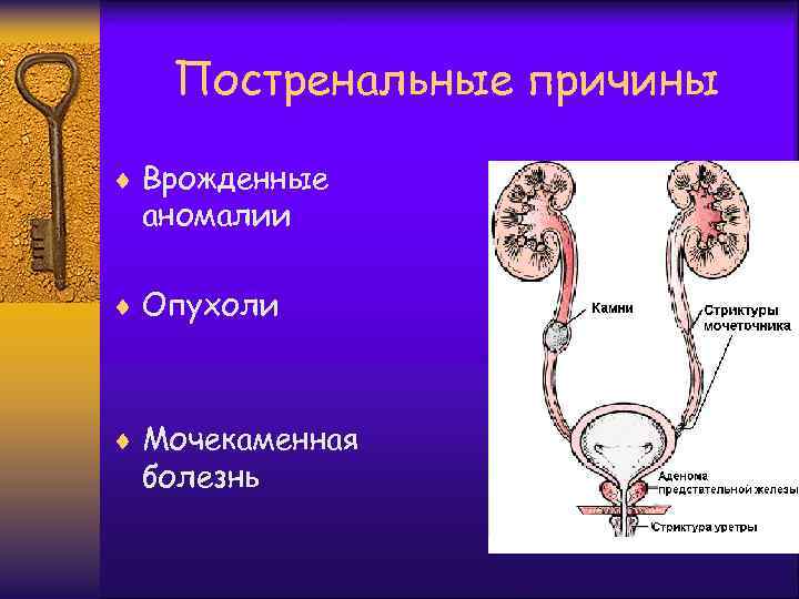 Постренальные причины ¨ Врожденные аномалии ¨ Опухоли ¨ Мочекаменная болезнь 
