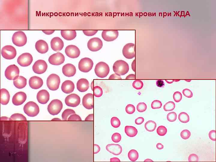 Микроскопическая картина крови при ЖДА 