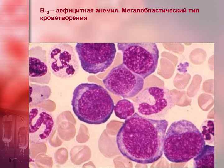 В 12 – дефицитная анемия. Мегалобластический тип кроветворения 