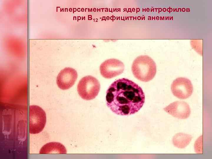 Гиперсегментация ядер нейтрофилов при В 12 -дефицитной анемии 