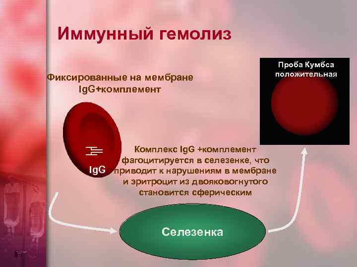 Иммунный гемолиз Фиксированные на мембране Ig. G+комплемент Проба Кумбса положительная Комплекс Ig. G +комплемент