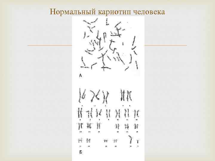 Нормальный кариотип человека 