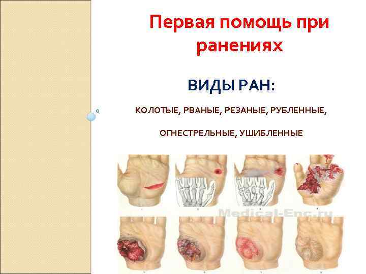 Первая помощь при ранениях ВИДЫ РАН: КОЛОТЫЕ, РВАНЫЕ, РЕЗАНЫЕ, РУБЛЕННЫЕ, ОГНЕСТРЕЛЬНЫЕ, УШИБЛЕННЫЕ 