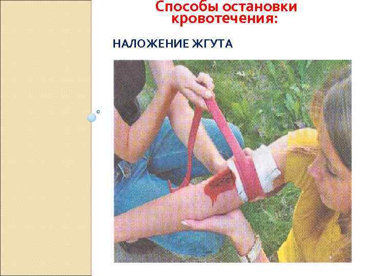 Способы остановки кровотечения: НАЛОЖЕНИЕ ЖГУТА 