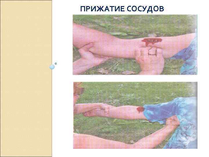 ПРИЖАТИЕ СОСУДОВ 