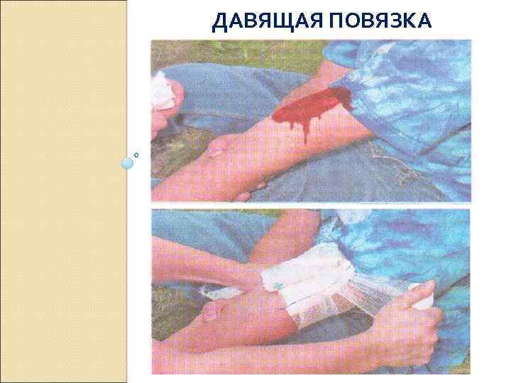 ДАВЯЩАЯ ПОВЯЗКА 