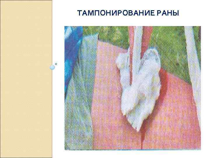 ТАМПОНИРОВАНИЕ РАНЫ 