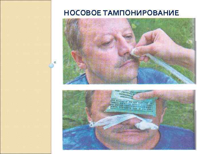 НОСОВОЕ ТАМПОНИРОВАНИЕ 