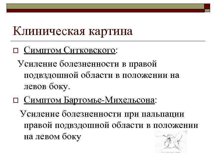 Клиническая картина Симптом Ситковского: Усиление болезненности в правой подвздошной области в положении на левов