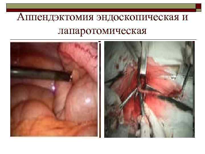 Аппендэктомия эндоскопическая и лапаротомическая 
