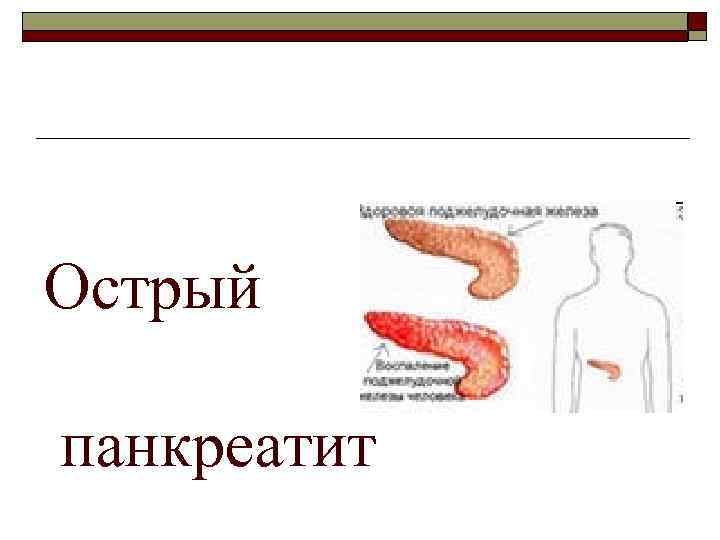 Острый панкреатит 