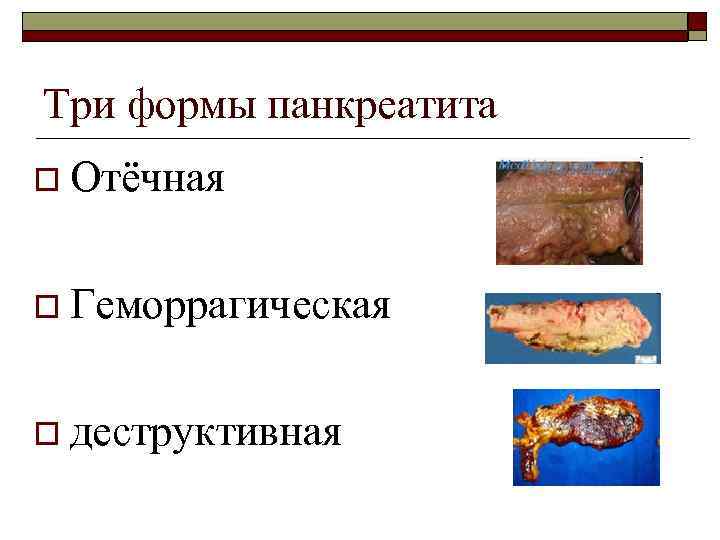 Три формы панкреатита o Отёчная o Геморрагическая o деструктивная 