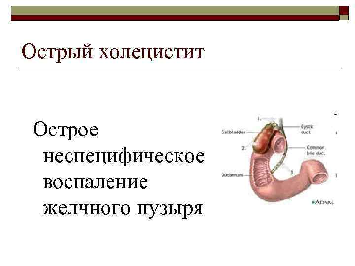 Острый холецистит Острое неспецифическое воспаление желчного пузыря 